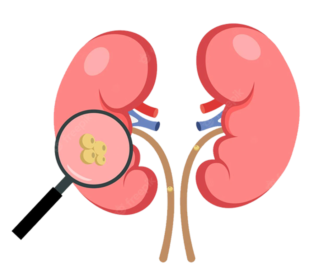 kidney-stone-surgery-treatment-cost-in-mumbai-ahc-aastha-health